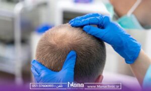 درمان ریزش مو در مشهد