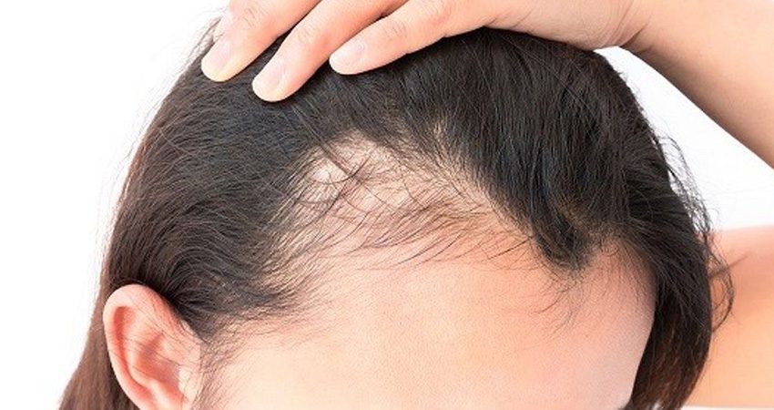 کاشت مو برای زنان پیشانی بلند