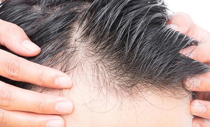 معرفی روش های موثر برای درمان ریزش مو
