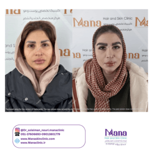 قبل و بعد کاشت ابرو در مشهد