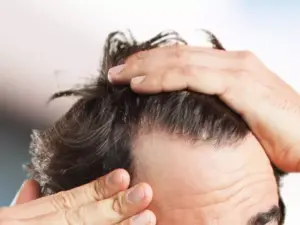 مهمترین عامل ریزش مو درمردان