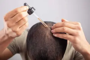 تاثیر ماینوکسیدیل بر درمان ریزش مو + عوارض و طریقه مصرف