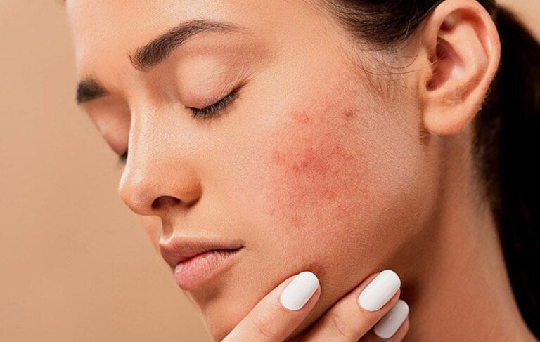کاهش جوش های هورمونی
