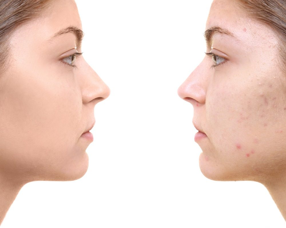 چگونه جای جوش ها را به روش طبیعی از بین ببریم