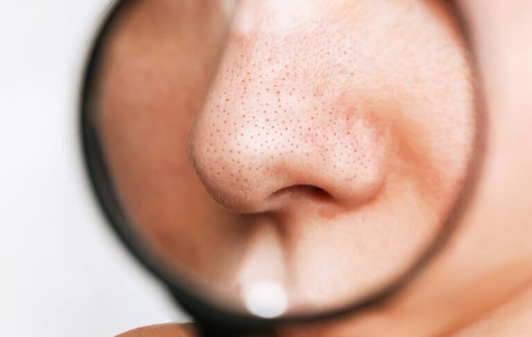 چگونه از بروز جوش‌های سرسیاه جلوگیری کنیم؟