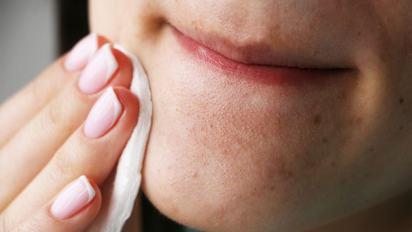 چگونه از بروز جوش‌های سرسیاه جلوگیری کنیم؟