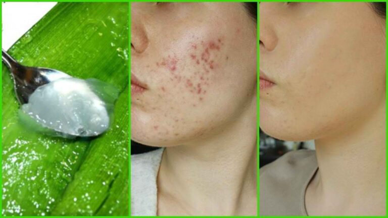 ماسک‌های خانگی برای درمان جوش و آکنه