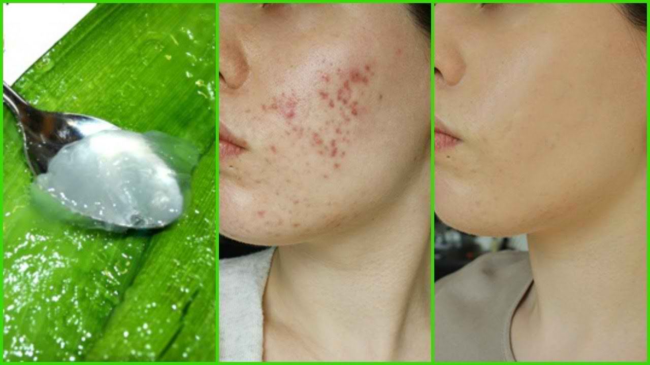 ماسک‌های خانگی برای درمان جوش و آکنه